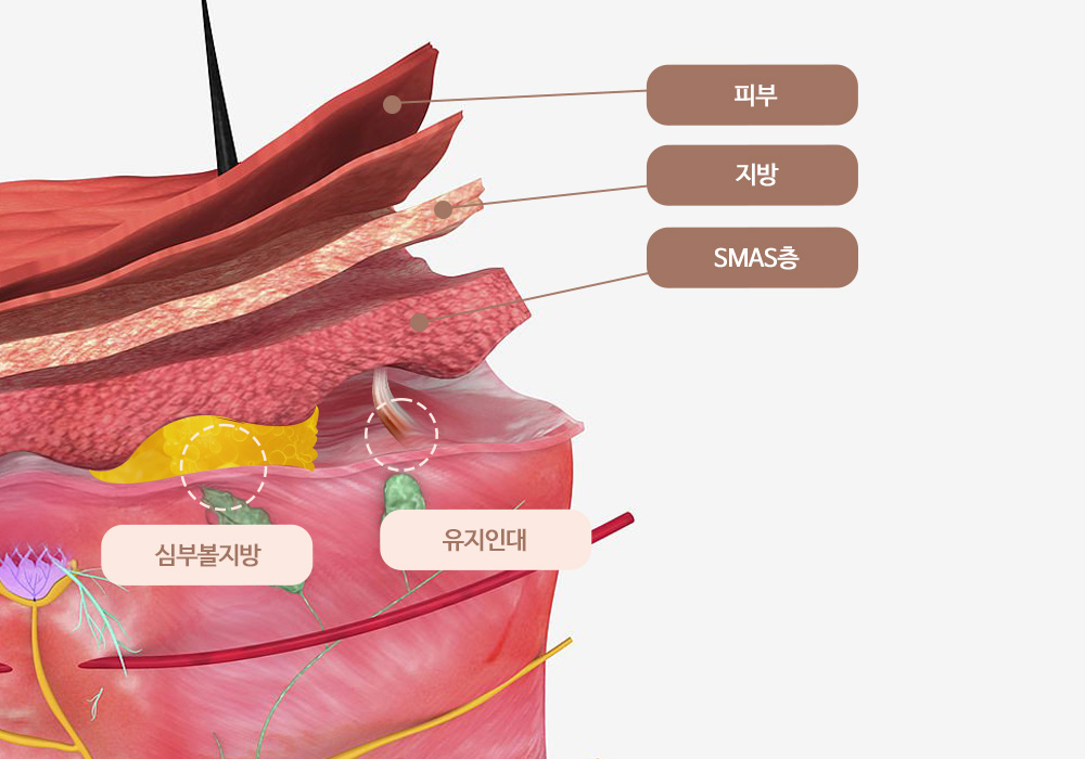 안면거상 재수술