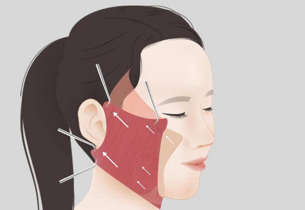 Facelift Revision