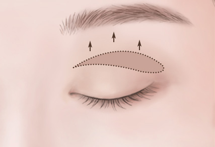 Upper Eyelid Surgery