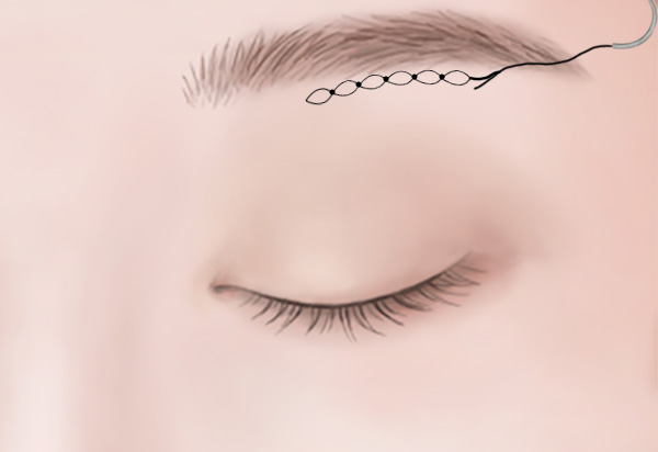 Eyebrow Lifting Surgery