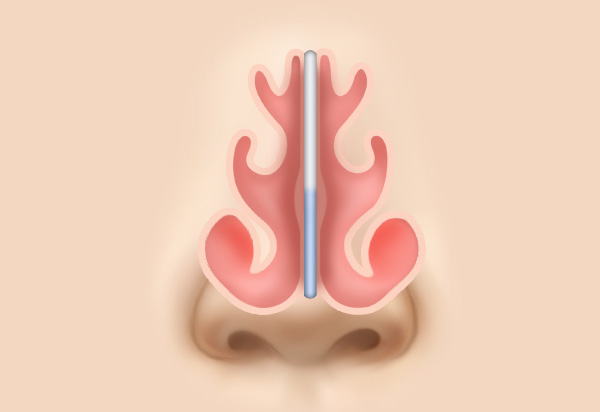 Functional Rhinoplasty