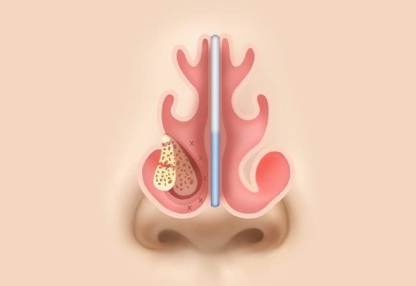 Functional Rhinoplasty