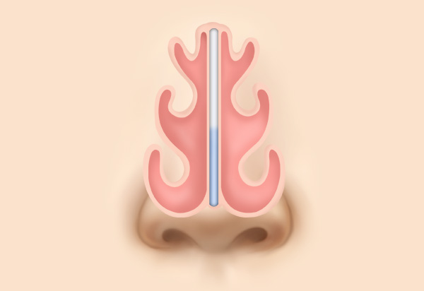 Functional Rhinoplasty