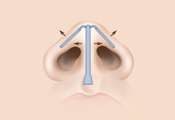 Functional Rhinoplasty