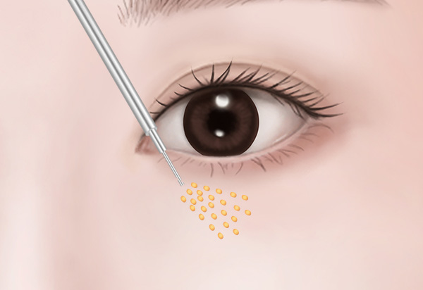 Undereye Fat Repositioning 