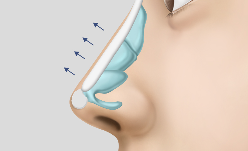 Contracted Nose Reconstruction