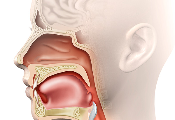 Rhinoplasty Revision