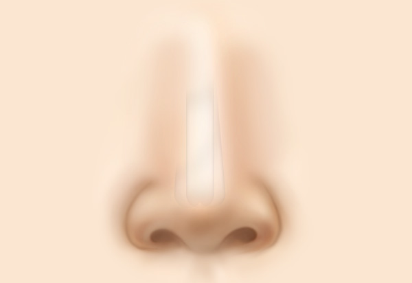 Rhinoplasty Revision