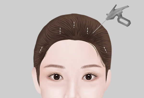 Endoscopic Forehead Lift