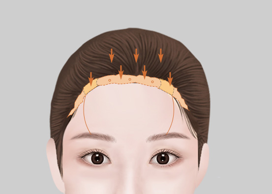 Forehead Reduction Surgery