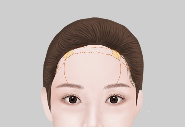 Forehead Reduction Surgery