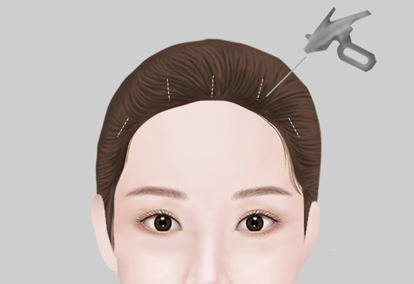 Forehead Reduction + Lift